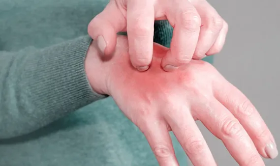 Şanlıurfa’da uyuz hastalığına karşı toplumsal uyarı